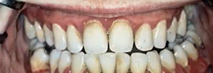 Parodontitistherapie in der allgemeinen Zahnarztpraxis