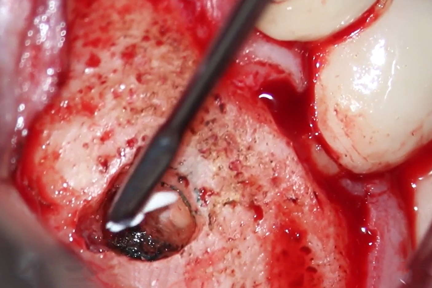 Endodontische Mikrochirurgie