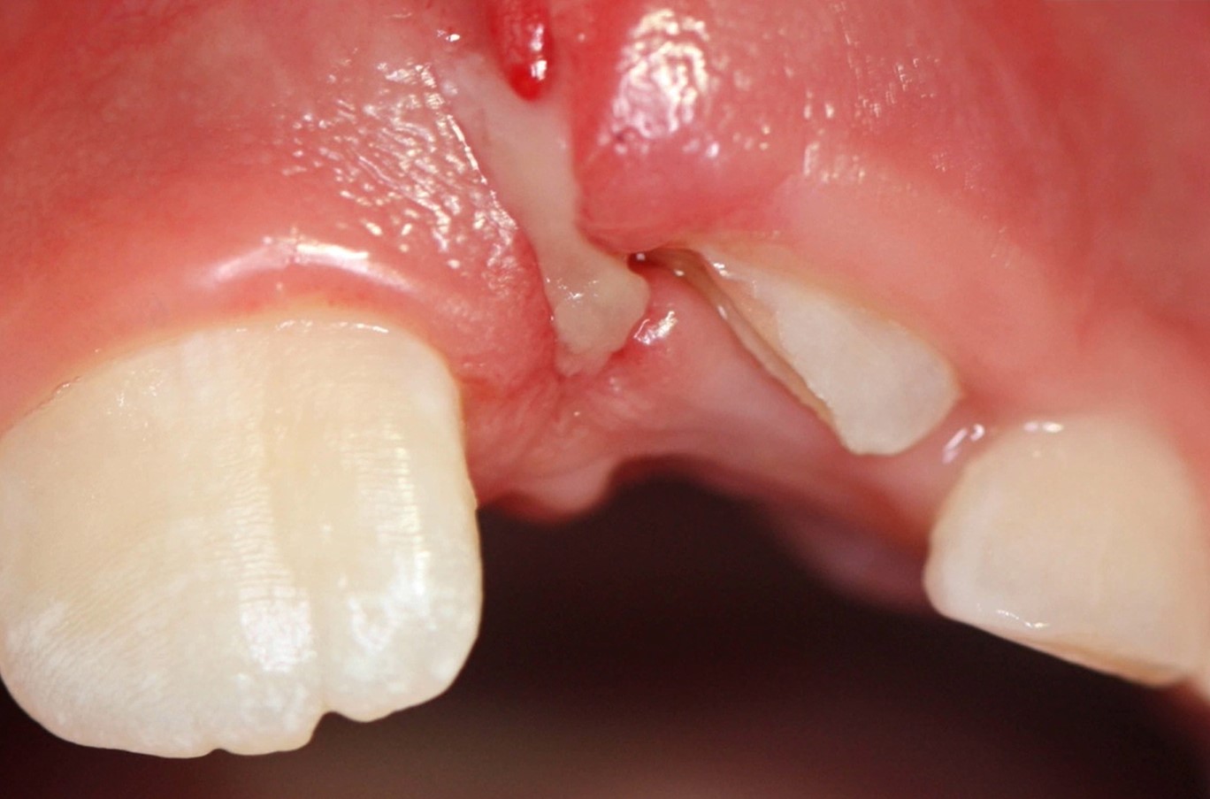 Unfallverletzungen der Zähne