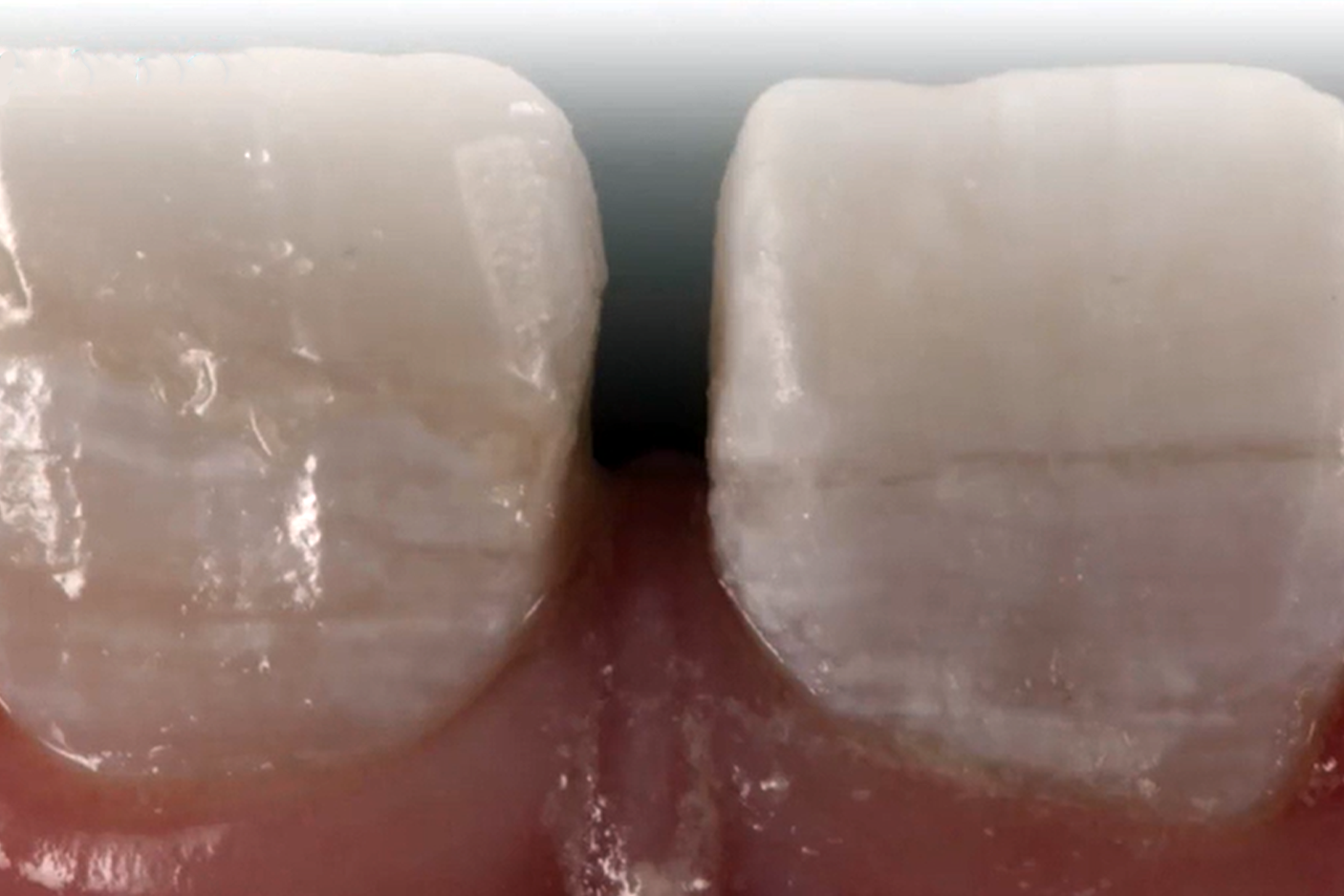 Pulpotomie bleibender Zähne